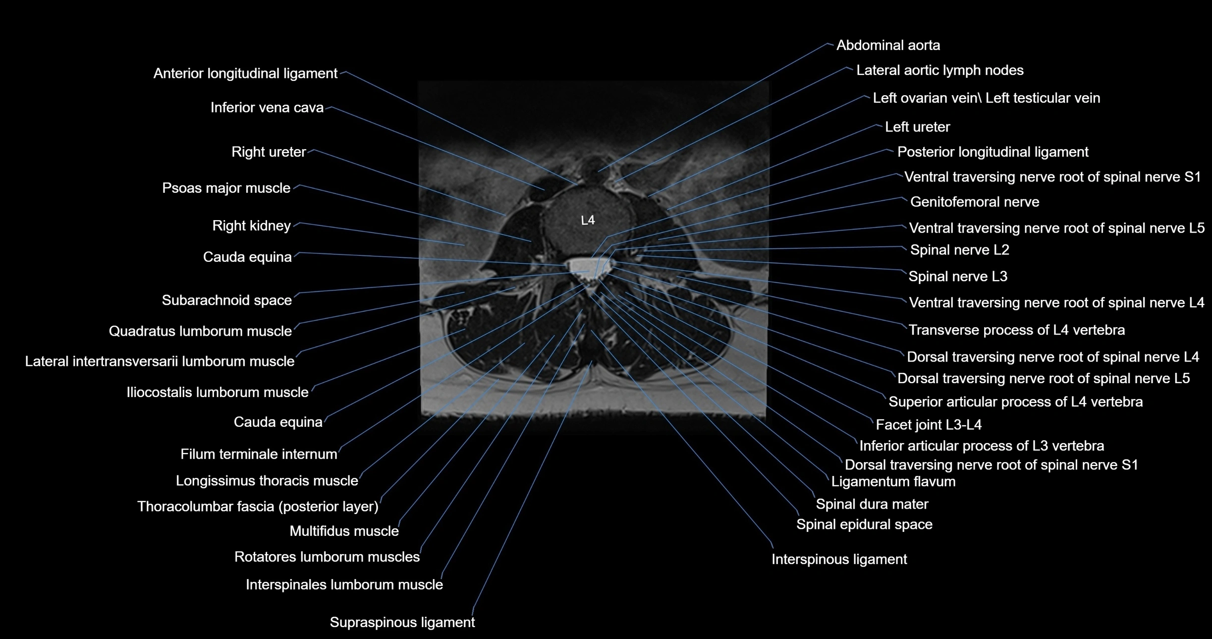 MRI lumbar spine axial cross sectional anatomy 3T radiology  image-img-00001-00028.webp